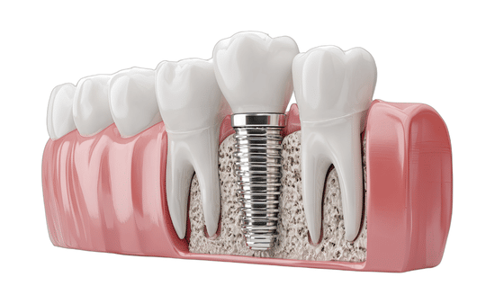 Dental Implants Replace the Tooth Root