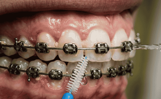 Hygiene Challenges Faced by Orthodontic Patients